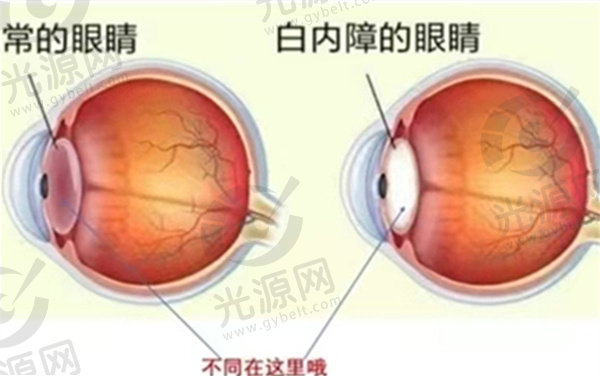 近视手术的几种类型