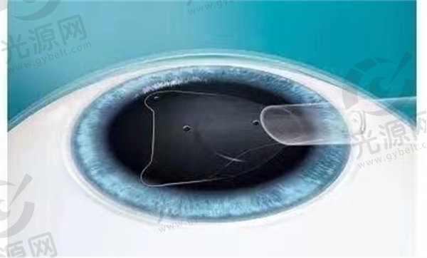 晶体植入近视手术价格收费