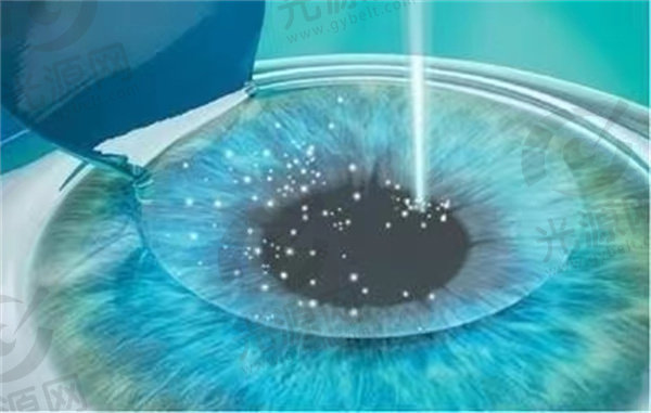 近视眼手术费主要的影响因素