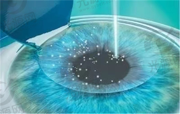 宁波太学眼科全飞秒近视手术价格收费