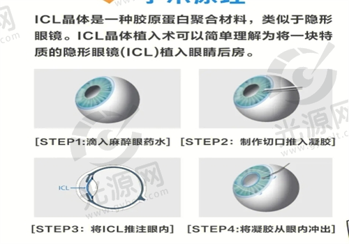 晶体植入近视眼手术