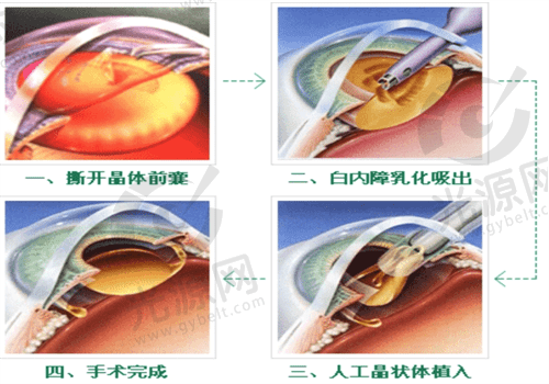 晶体植入手术