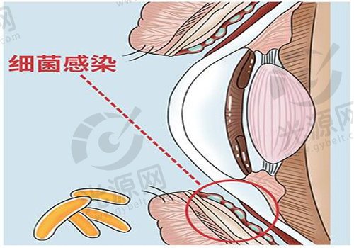 结膜炎不一定是红眼病