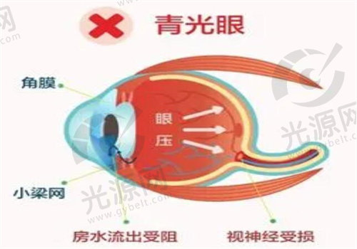 青光眼可以通过做手术治 愈吗