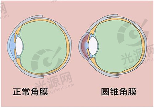 圆锥角膜不可以做全飞秒手术的原因