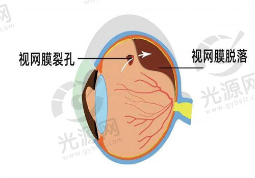 视网膜脱落是否可以治 愈，要根据实际情况而决定