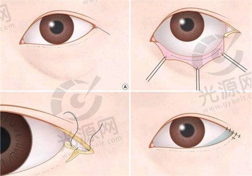 先天小睑裂综合症手术有手术操作风险