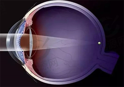 半飞秒近视手术的优势