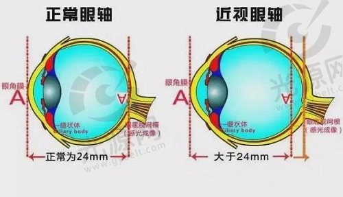 儿童眼轴变长可以恢复吗