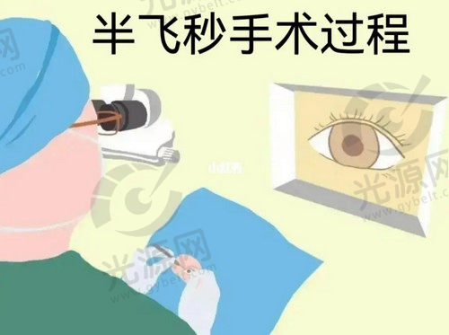 800度近视可以做激光手术