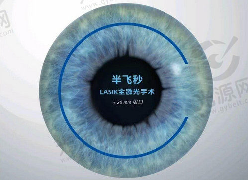 半飞秒激光手术
