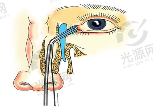 泪囊鼻腔吻合术是小手术还是大手术