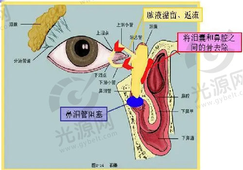 泪囊鼻腔吻合术适应与禁忌症