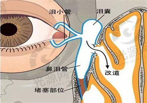 泪囊鼻腔吻合手术过程