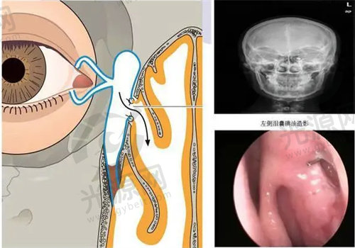 泪囊鼻腔吻合并发症