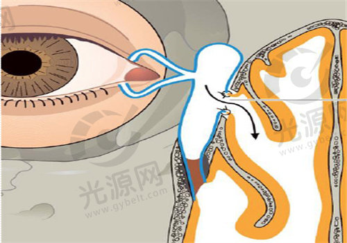 泪囊鼻腔吻合术平复期是多少