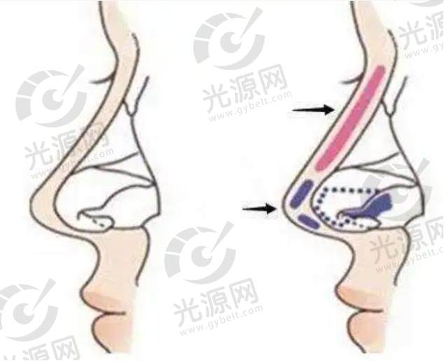 硅胶假体隆鼻.jpg