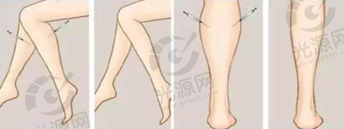Botox注射瘦小腿.jpg