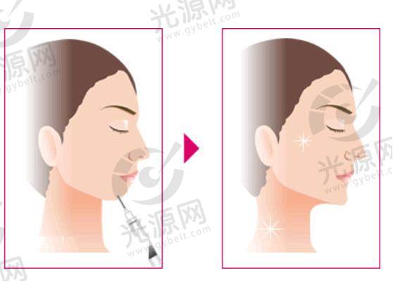 玻尿酸垫下巴.jpg