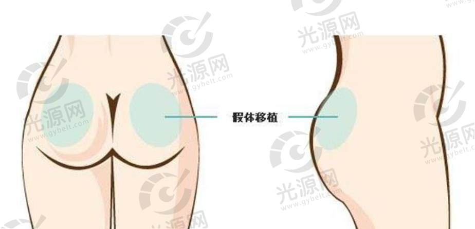 假体丰臀.jpg