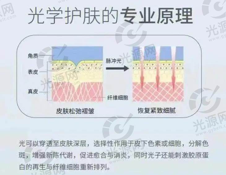 光子嫩肤.jpg