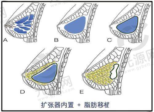李发成脂肪填充面部怎么样？