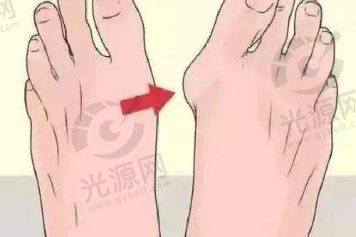曹医生的特色技术:双眼皮手术的成功实例