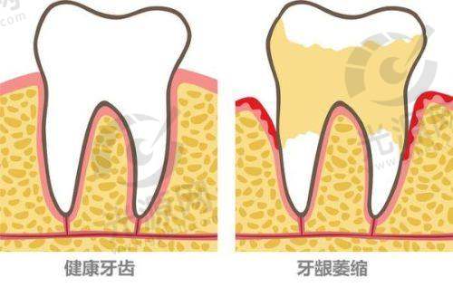 种植牙5年后的感受：口腔健康显著提升
