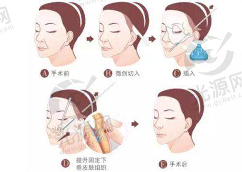 合肥一加一做双眼皮怎么样?