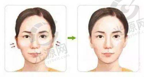双眼皮修复:罗金刚医生的独特技术与实例分析