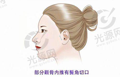 三、福州秀清整形医院真实患者实例分享