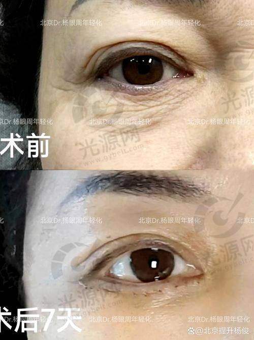 昆明哪里做双眼皮好的医生是排名第七：郭鹏医生