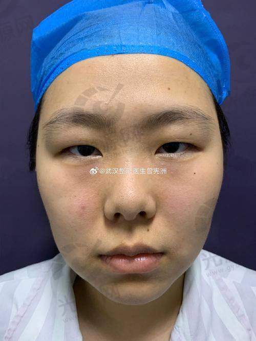三、韩国艾源整形医院口碑如何不妨来看集美们的实例评价