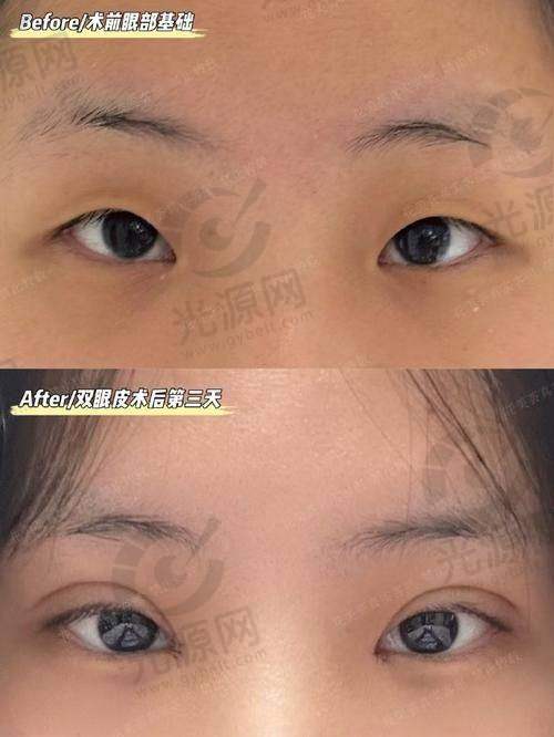 二、昆明哪里做双眼皮好的医生是详细介绍