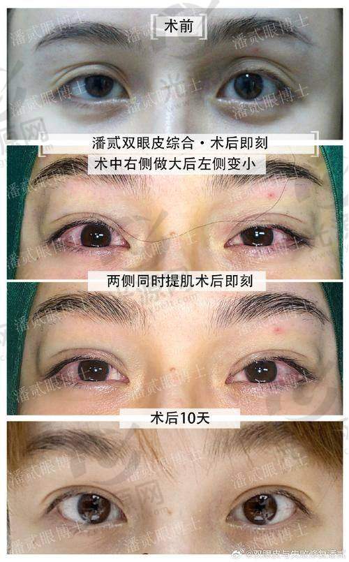 昆明哪里做双眼皮好的医生是排名第六：李韬医生
