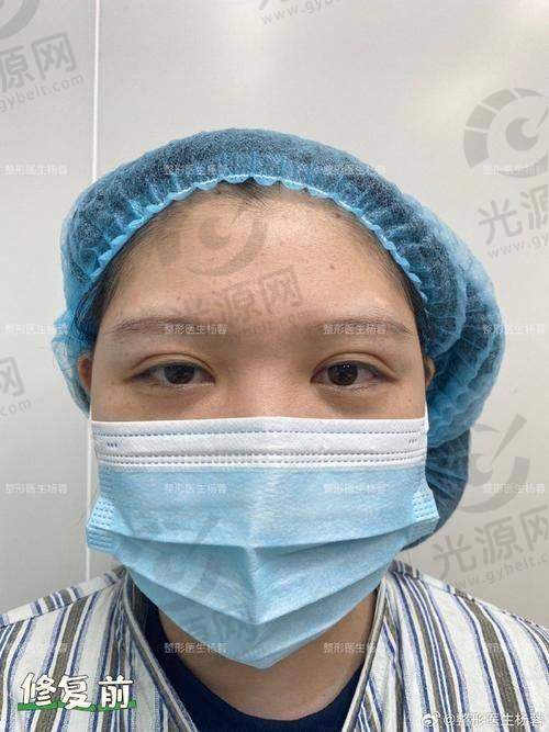 昆明哪里做双眼皮好的医生是排名第九：乔奇医生