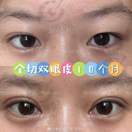 昆明韩辰整形医院医生技术实力强大，双眼皮手术效果自然，深受求美者好评！