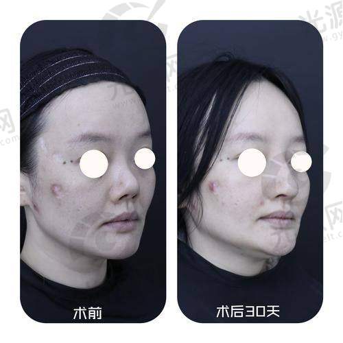 深圳整鼻子比较有名的医生排名第一：李信锋医生