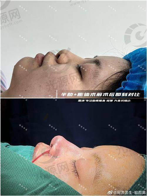 福州做鼻子出名的医生预约挂号方式