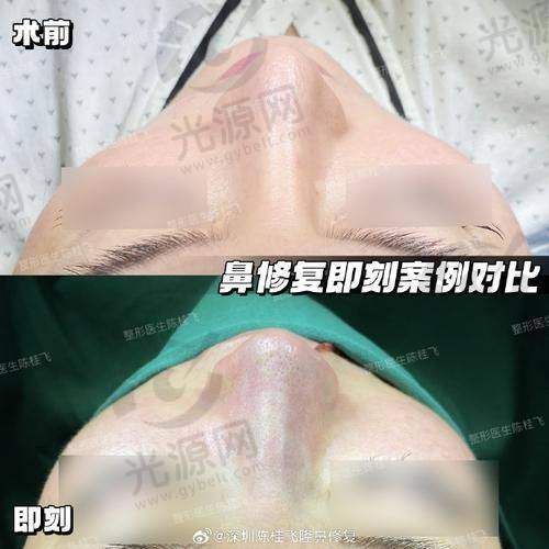 北京做鼻子好的医生排名第四：吴玉家医生