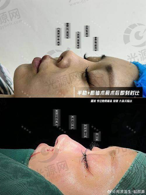 福州做鼻子出名的医生排名第二：薛克墘医生