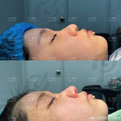 深圳整鼻子比较有名的医生排名第二：向宏伟医生