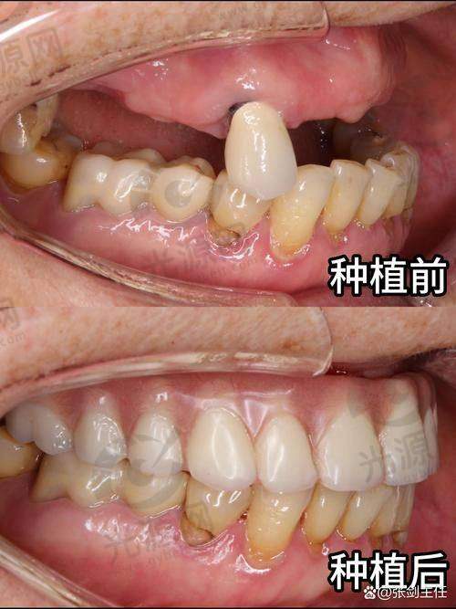 韩国进口种植牙的价格结构