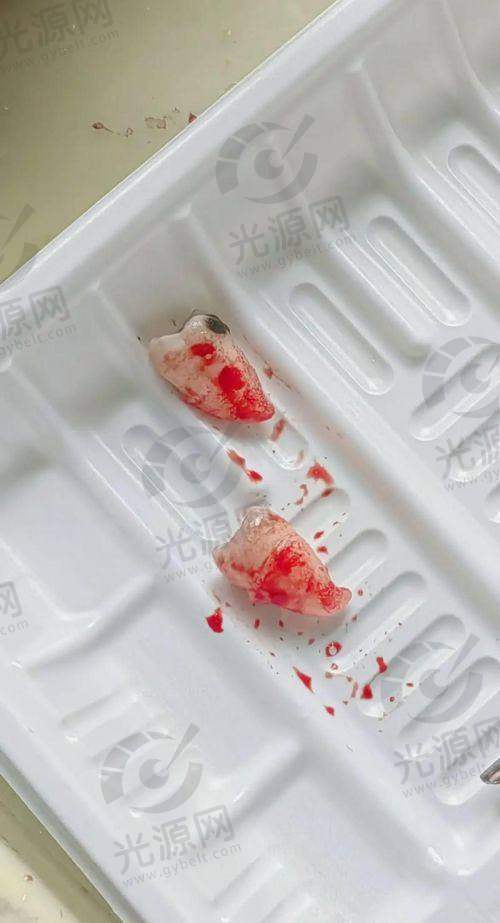 横生智齿患者的注意事项