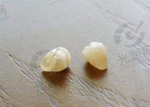 铂晶瓷全瓷牙的临床成效与使用实例