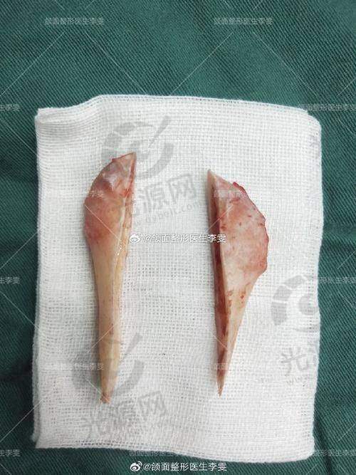 金一秀磨骨价位与其他医生对比
