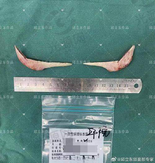 金一秀磨骨费用的影响因素