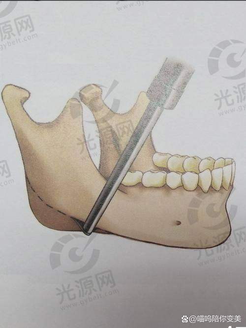 金一秀磨骨价格多少？详细解析手术费用