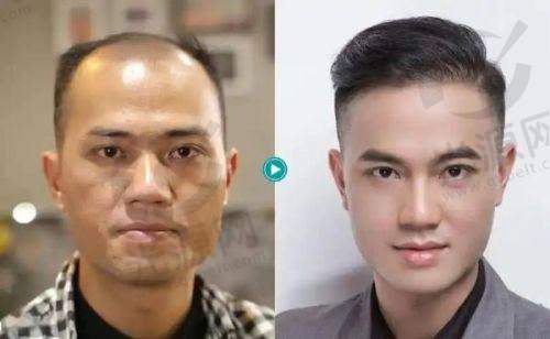 三、徐州新生毛发医院的真实评价与亲身实例