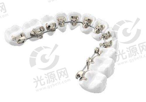 陶瓷牙套较厚影响舒适度